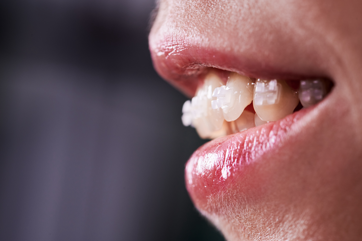 Close-up of a young woman with braces on her teeth, smiling and demonstrating white teeth. The image highlights orthodontic treatment and how the tongue can influence teeth alignment.