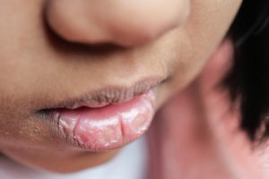 The Importance of Saliva: How Dry Mouth Impacts Oral Health
