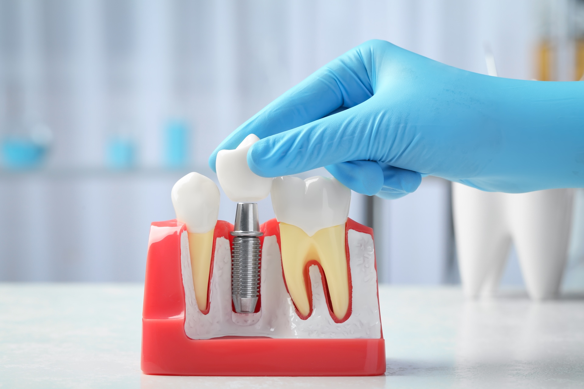 When Is It Time to Replace Fillings or Crowns