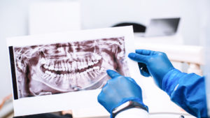 When Should Wisdom Teeth Be Removed